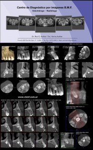 Tomografia Cone bEAM 1.3- Incluido